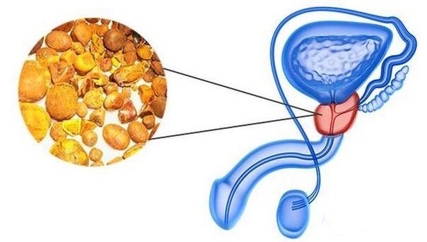 Calcification in the prostate