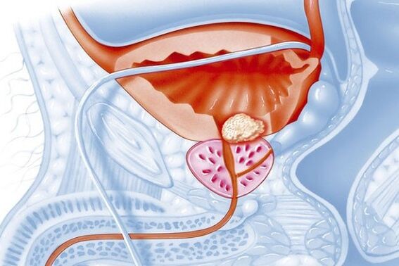 Inflammatory process of the prostate