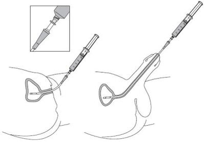 Drop the drug solution in the urethra