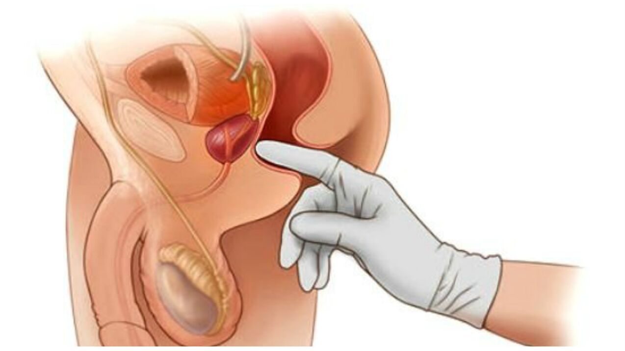 Prostate massage to treat chronic prostatitis