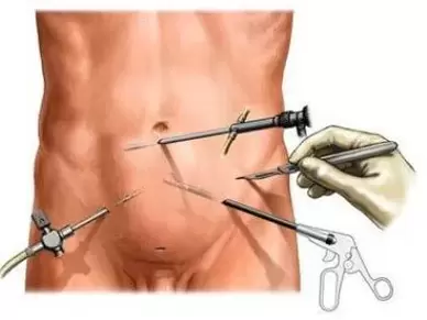 Surgical treatment of chronic prostatitis