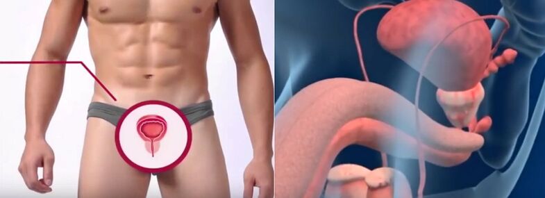 Prostatitis in men, identifiable by certain signs
