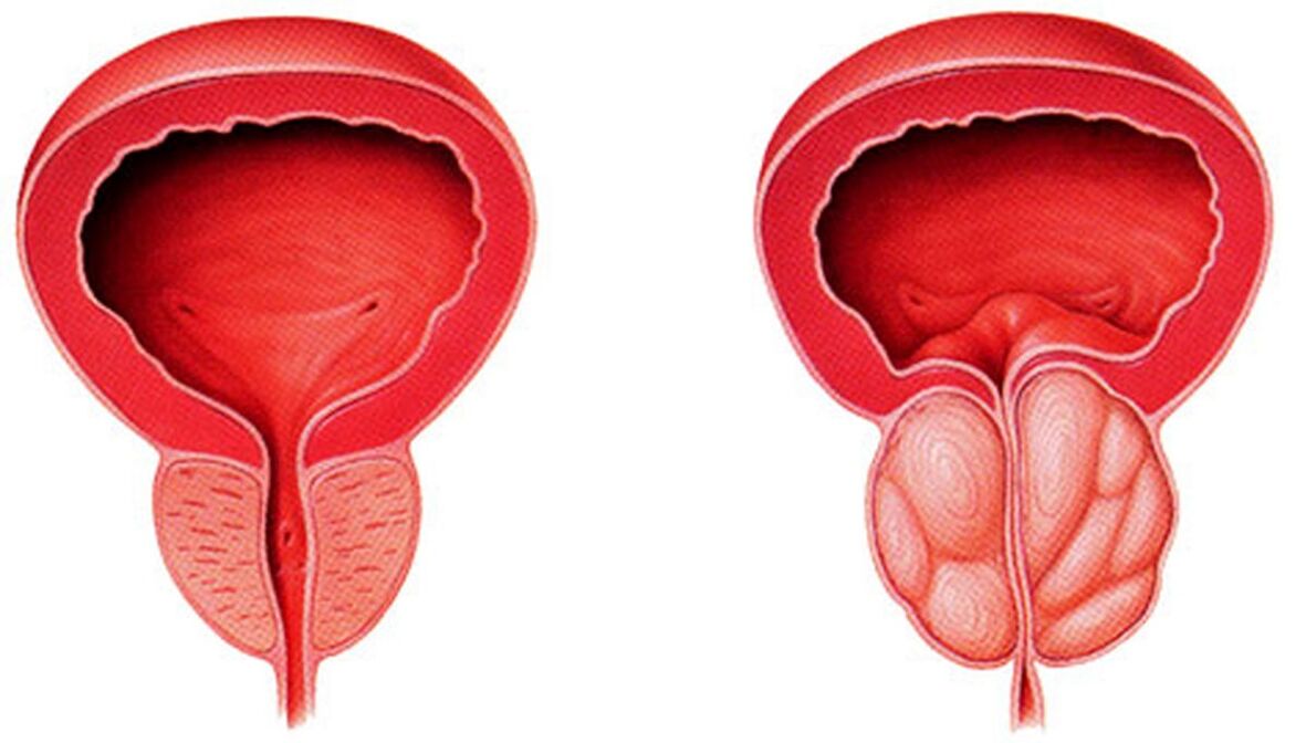 Healthy and inflamed prostate with prostatitis