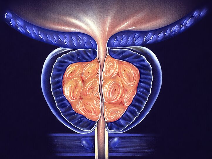 Inflamed prostate and prostatitis prevention