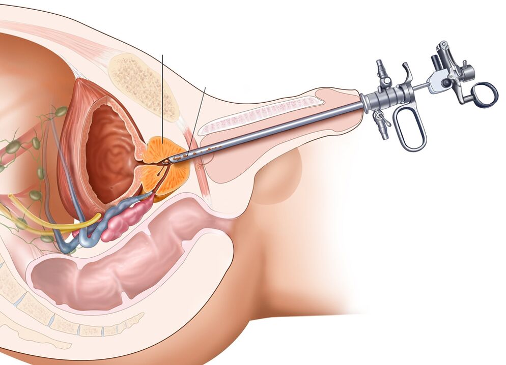 Transurethral resection of the prostate allows you to remove the affected part of the organ