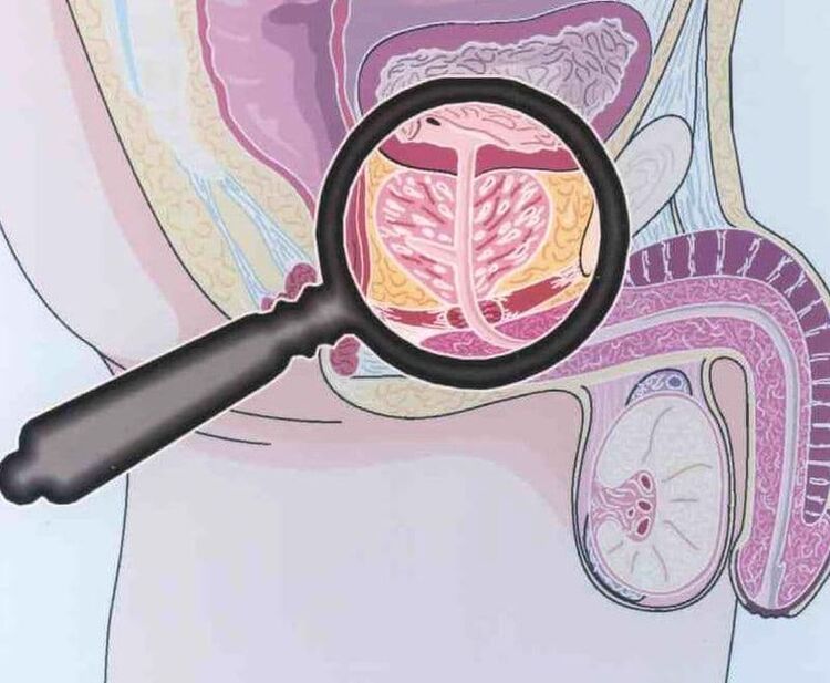 Prostate tissue damage in men with chronic prostatitis