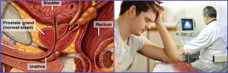 To diagnose chronic prostatitis in men, prostate ultrasonography is required. 