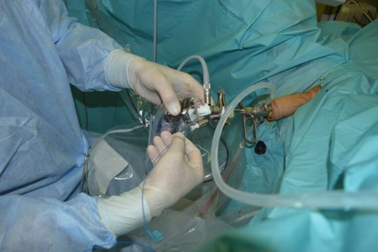 Transurethral resection of the prostate for chronic prostatitis